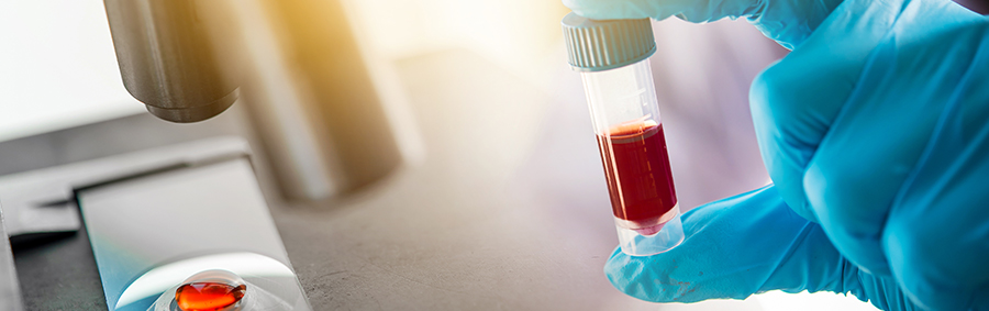 Forskning om Parkinson – blodprov i laboratoriemiljö